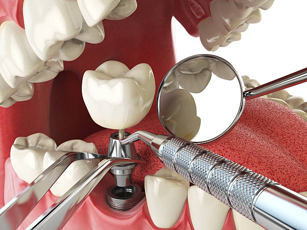 Best Emergency Wisdom Teeth Removal in Mckinleyville, CA